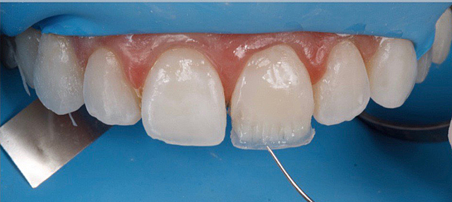 RL Bowen (Restauración Directa)