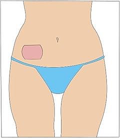 Parche anticonceptivo