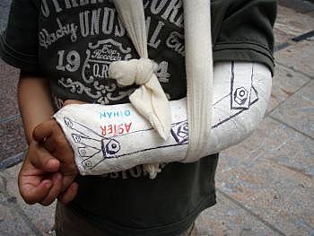 Em vaig trencar el braç, quant em vaig caure per les escales.