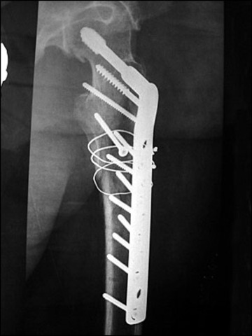 cirujia pierna izquierda