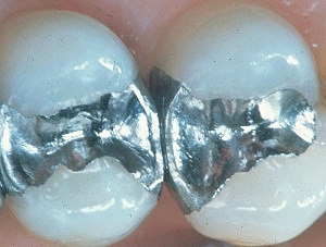 August Taveau de París combinó plata y mercurio para formar una pasta de plata, dando como resultado la amalgama