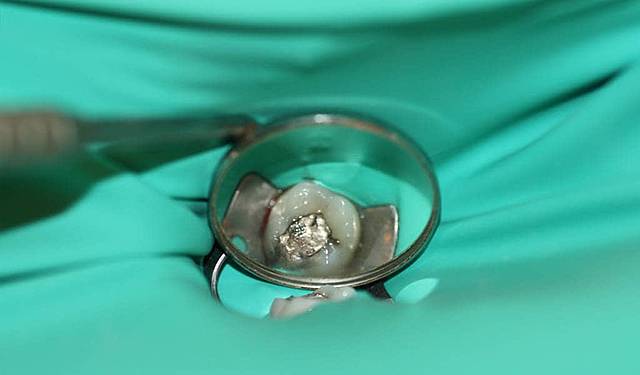 ¿Fin de la amalgama?