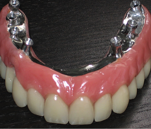 "Técnica con dientes de porcelana"