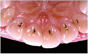 Lamina de oro cohesiva