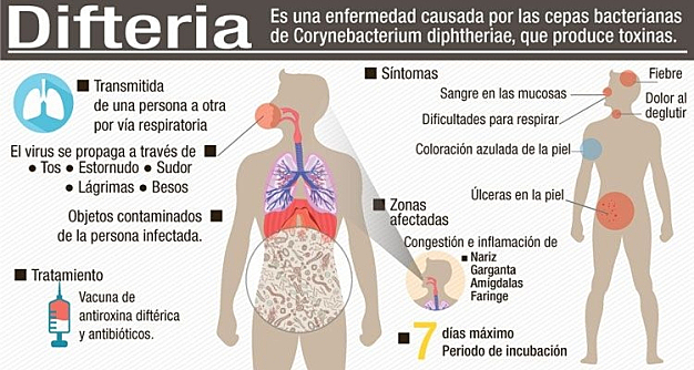 Caso de difteria