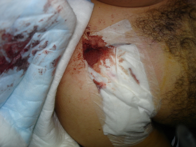 me operaron del hombro