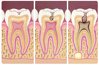 Teoría Quimicobacteriana
