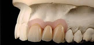 "Polimetil metacrilato"