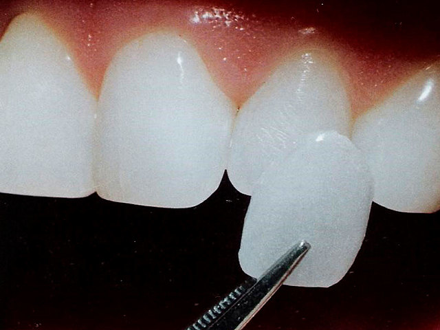 Patente del primer material de porcelana