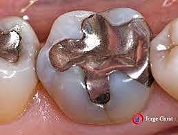 DESARROLLO DE AMALGAMA CON ALTO CONTENIDO DE COBRE