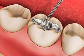 Inicio de la amalgama