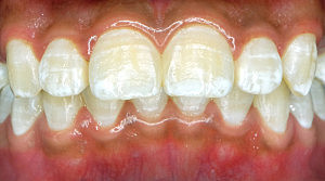 Fluorosis