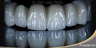 Compuesto Dental de Porcelana