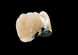 Corona de Metal-Cerámica