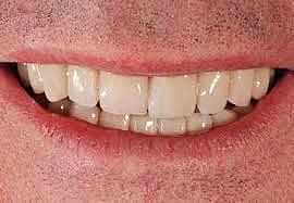 Introducción de  las restauraciones Procera totalmente cerámicas