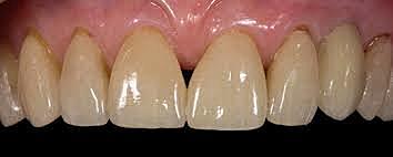 Compuesto reforzado con fibra