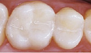 GIC condensable / autoendurecible