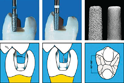 Preparación de cavidad