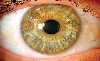 Lente intraocular