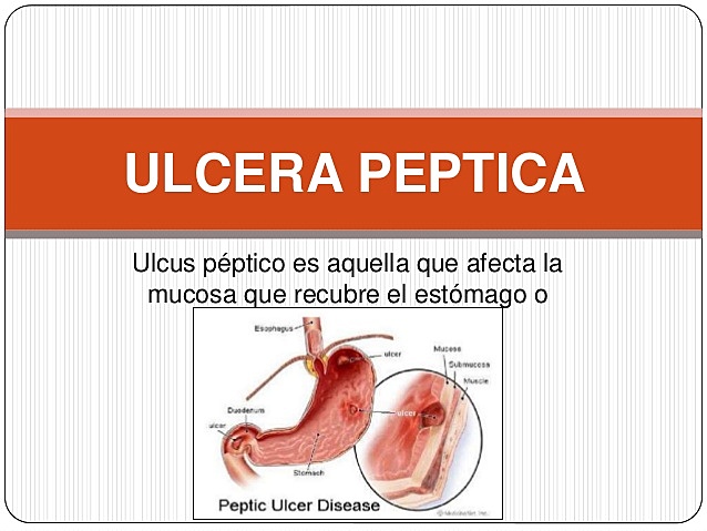 Helicobacter pylori en gastritis y úlcera péptica