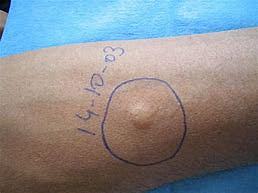 Inflamaciones hipersensibilidad retardada