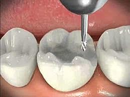 Preparación cavitaria