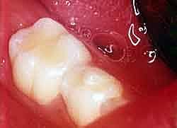 Ionómero de vidrio modificado con resina