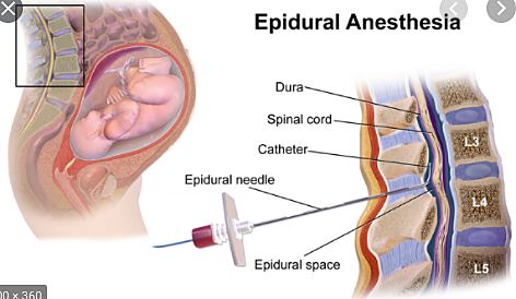 Use of Epidural