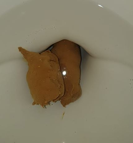 Reportó Dolor Abdominal