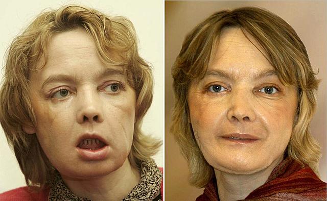 Transplantament de cara