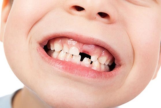 s'hem cau la primera dent