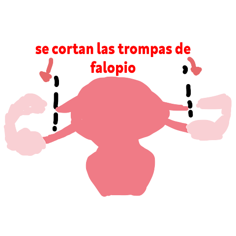 Ligaduras de Trompas