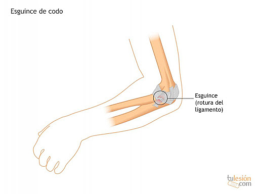 Me esguince el brazo