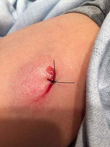 Ma première grande blessure