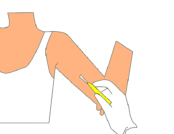 Los implantes subdérmicos.