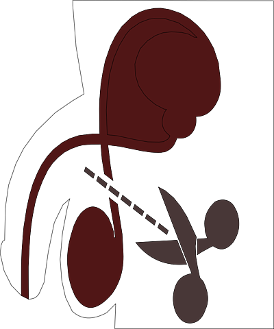 Vasectomia