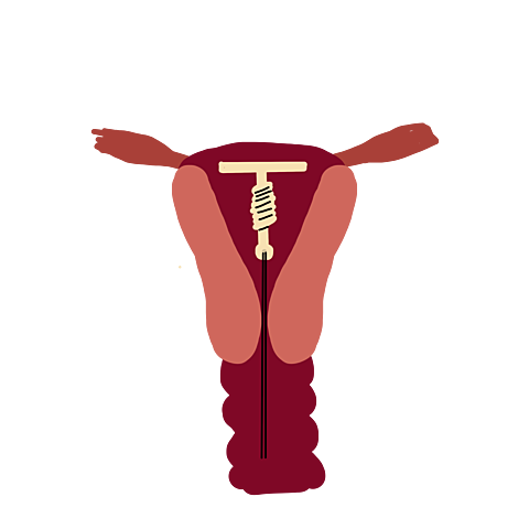 Dispositivo Intrauterino de Cobre (DIU)