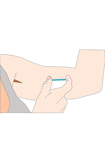 IMPLANTE ANTICONCEPTIVO