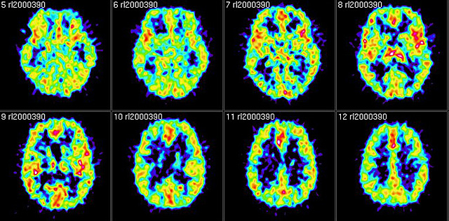AVANCES EN LA NEUROPSICOLOGÍA