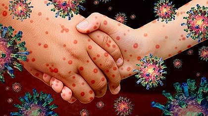 Epidemias de sarampión, difteria y peste bubónica aparecidas en Europa