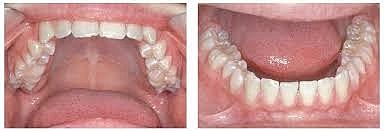 Segundo Período de Recambio