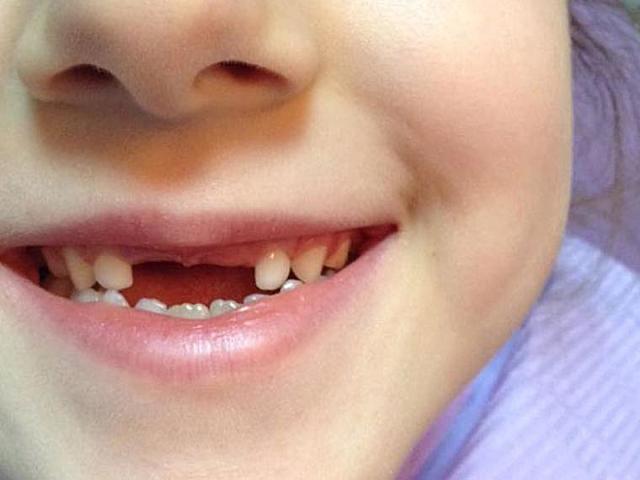 Em trenco quasi tots les dents