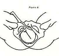 Maniobra de LaChapelle