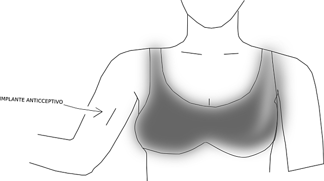 El implante anticonceptivo