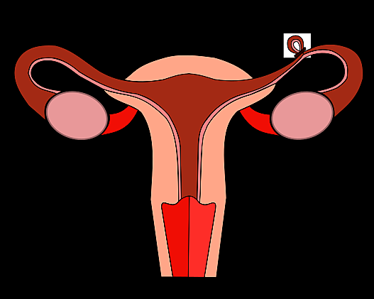 Salpingoclasia (ligadura de trompas)