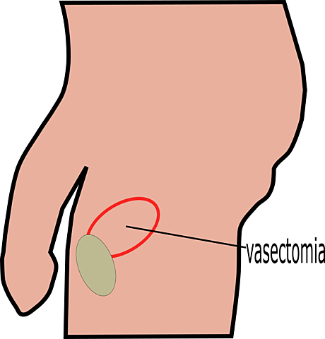 esterilización masculina
