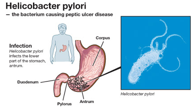 Helicobacter pylori como causante de gastritis