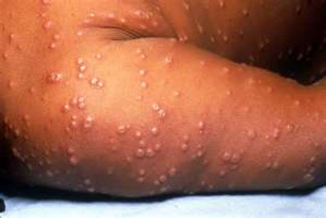 smallpox vacsination