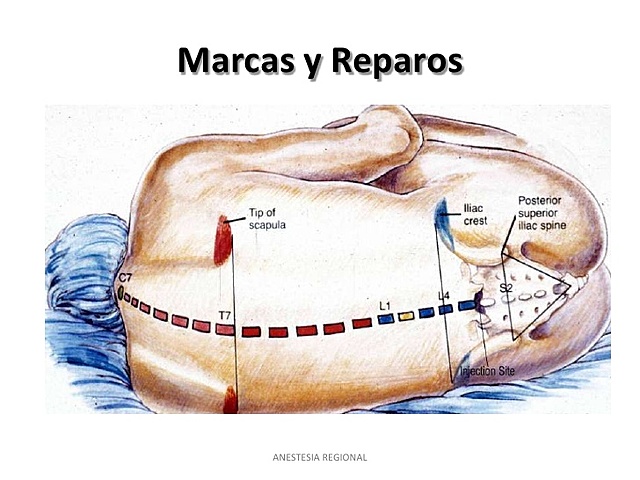 Introducción de nuevas anestesias