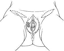 Vulvectomia